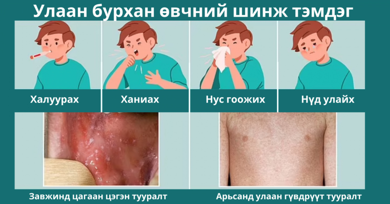 УЛААНБУРХАН ӨВЧНӨӨС ХЭРХЭН СЭРГИЙЛЭХ ВЭ 